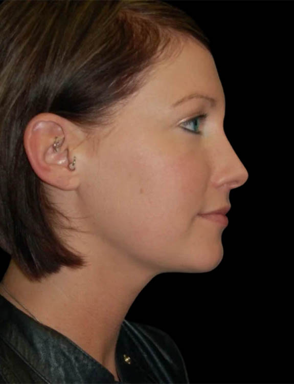 Neck Liposuction case #4970