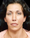 Blepharoplasty case #3487
