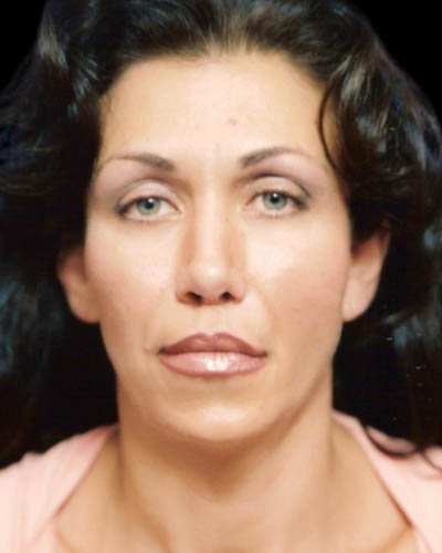 Blepharoplasty case #3487