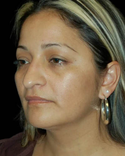 Facial Fat Grafting case #4527