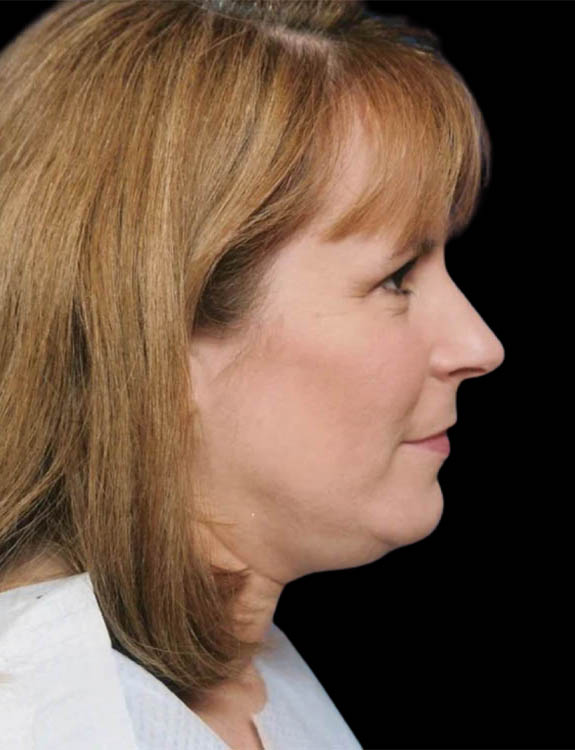 Neck Liposuction case #4946