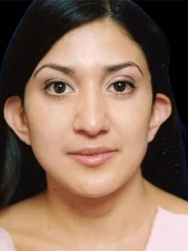 Otoplasty case #5029