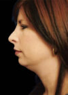 Chin Implant case #4212