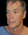 Facelift case #4417