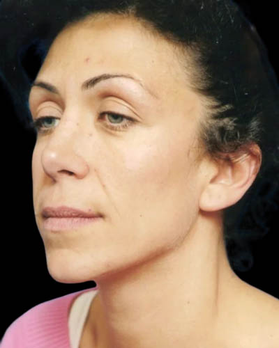 Blepharoplasty case #3487