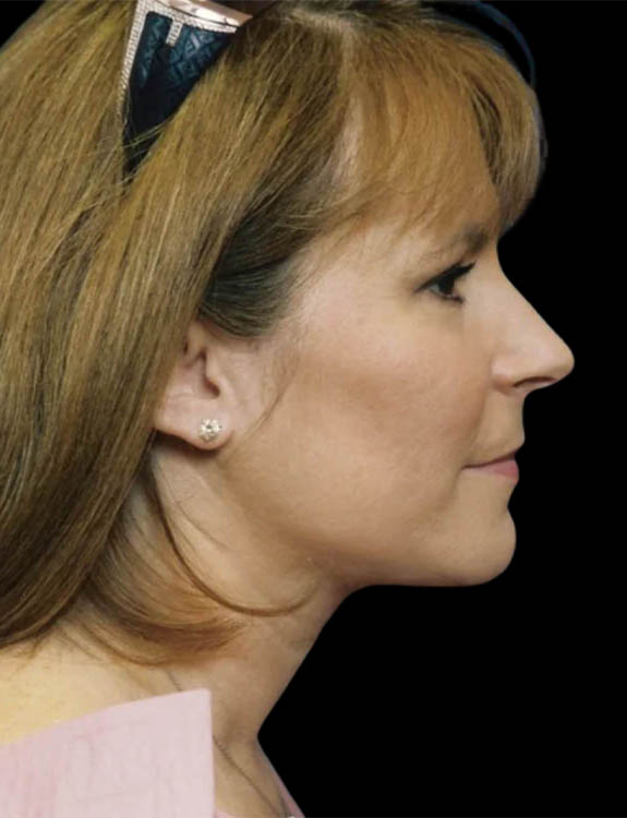 Neck Liposuction case #4946