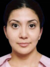 Otoplasty case #5029