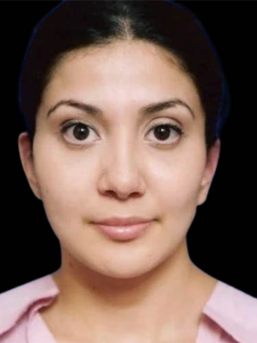 Otoplasty case #5029
