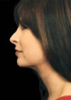 Chin Implant case #4212
