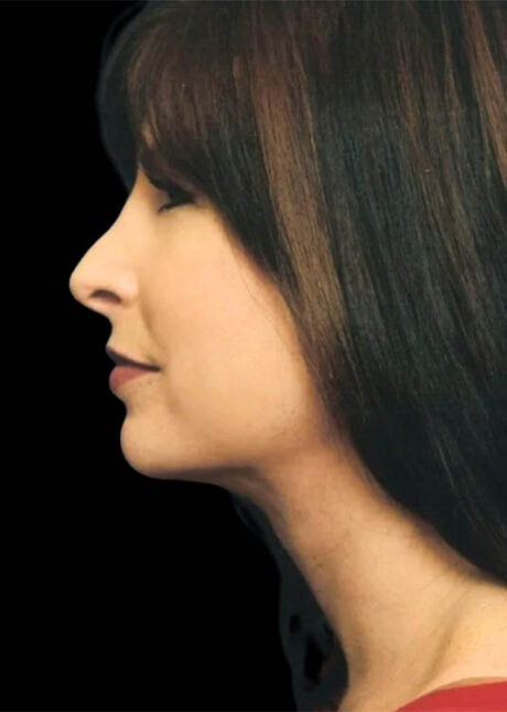 Chin Implant case #4212