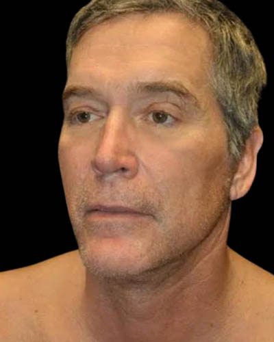 Facelift case #4417