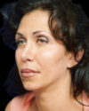 Blepharoplasty case #3487
