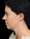 Neck Liposuction case #4938