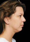 Chin Implant case #4209