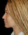 Facial Fat Grafting case #4514