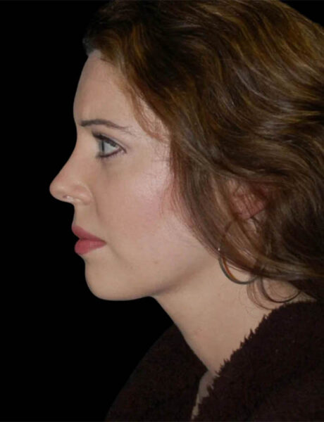 Neck Liposuction case #4938