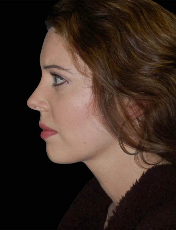 Neck Liposuction case #4938