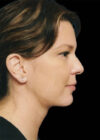 Chin Implant case #4209