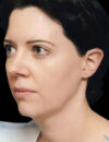 Neck Liposuction case #4938