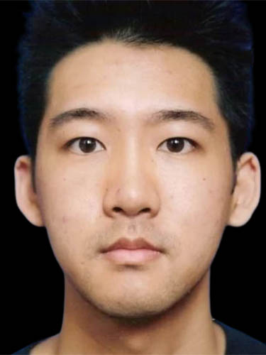 Otoplasty case #5014