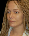 Facial Fat Grafting case #4514