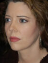 Neck Liposuction case #4938