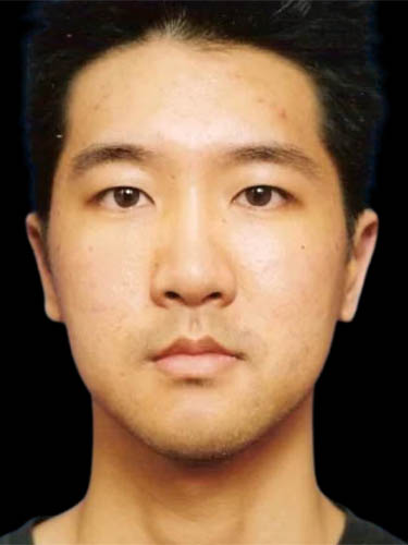 Otoplasty case #5014
