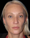 Facial Fat Grafting case #4506