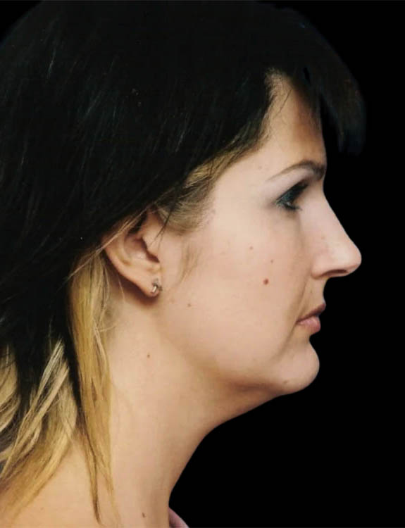 Neck Liposuction case #4930