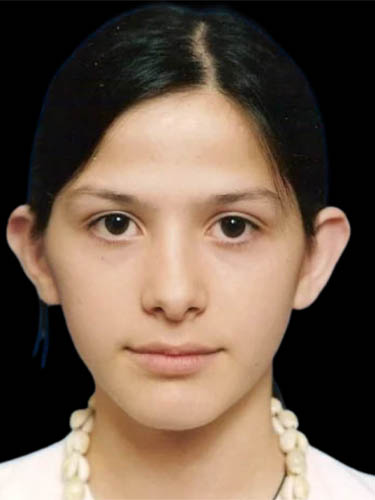 Otoplasty case #5002