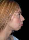 Chin Implant case #4193
