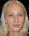 Facial Fat Grafting case #4506