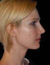 Neck Liposuction case #4930