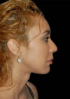 Chin Implant case #4193