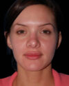 Facial Fat Grafting case #4500