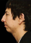 Chin Implant case #4196