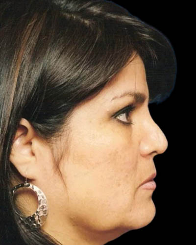 Facelift case #4388