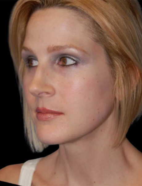 Neck Liposuction case #4930