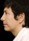 Chin Implant case #4196