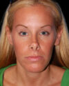Facial Fat Grafting case #4495