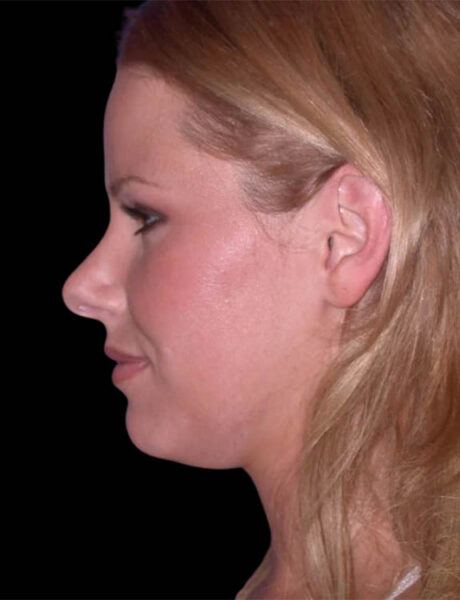 Neck Liposuction case #4922