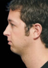 Chin Implant case #4186