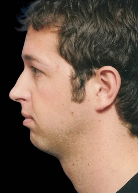 Chin Implant case #4186