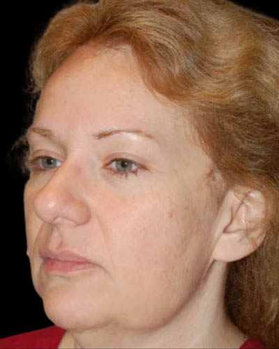 Facelift case #4376