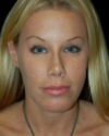 Facial Fat Grafting case #4495