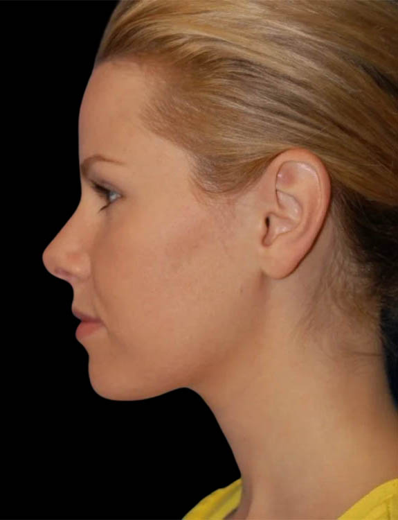 Neck Liposuction case #4922