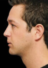 Chin Implant case #4186