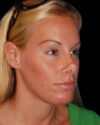 Facial Fat Grafting case #4495