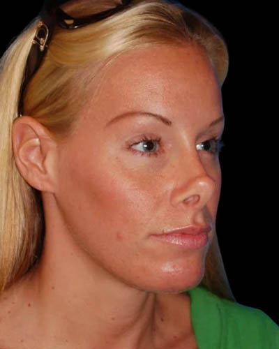 Facial Fat Grafting case #4495