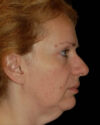 Facelift case #4376